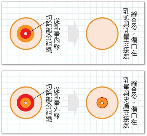 乳暈生毛|乳頭邊長了毛，是什麼病？該不該拔？讓名醫一次解釋給您聽｜每